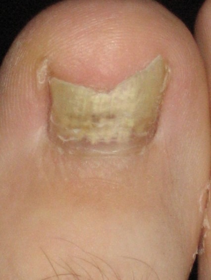 a toe with fungal infection