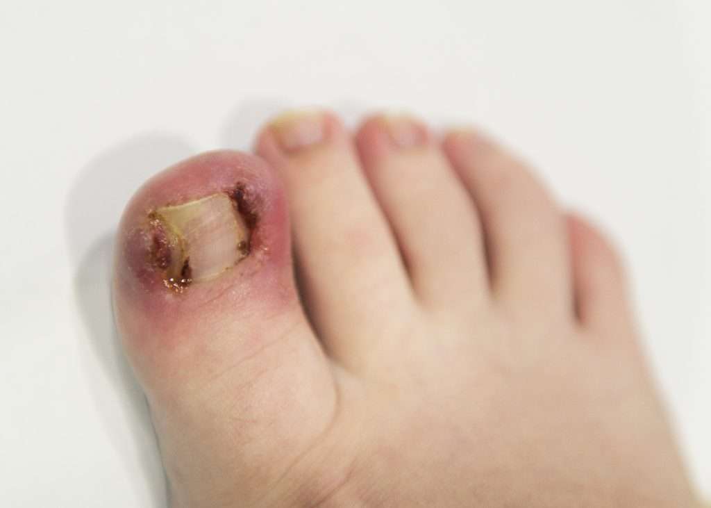 Ingrown