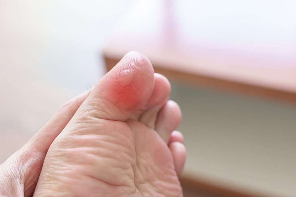 Blisters