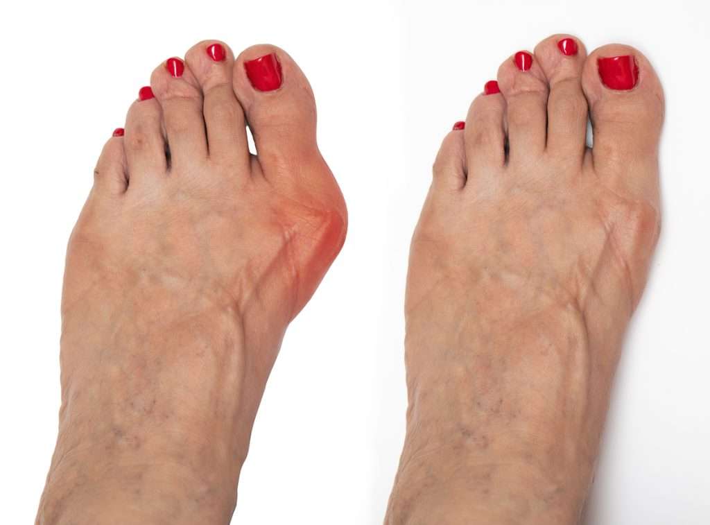 Foot Bunions