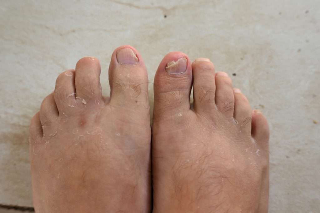 A photo of a patient's foot suffering from a fungal nail infection