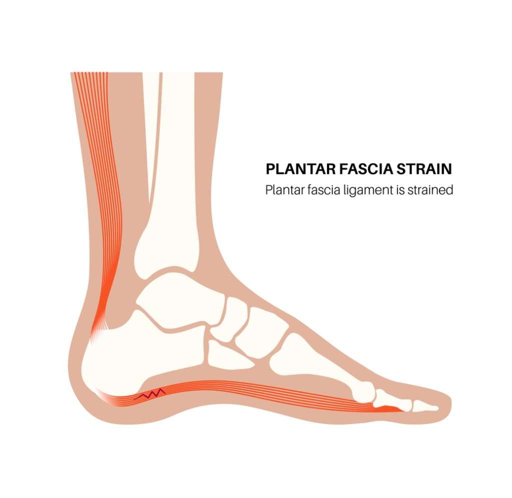Medical illustration of a human foot affected by plantar fasciitis