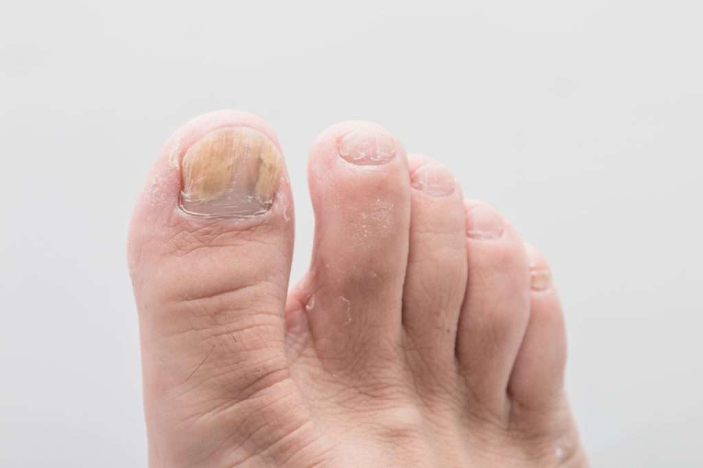 A photo of a toenail fungus