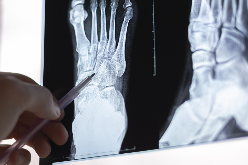 How Many Bones Are in Your Feet?