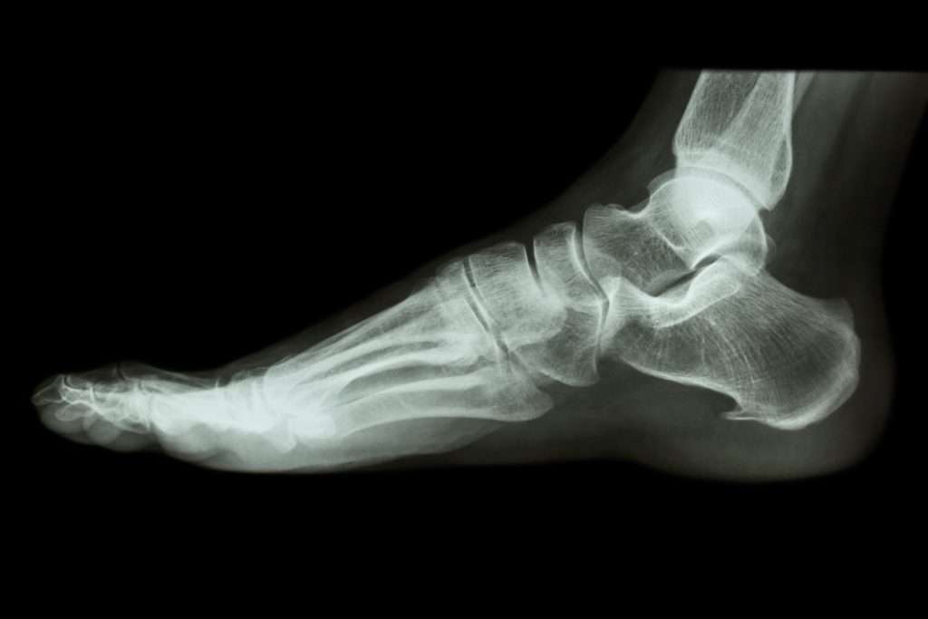 X-ray normal human's foot lateral
