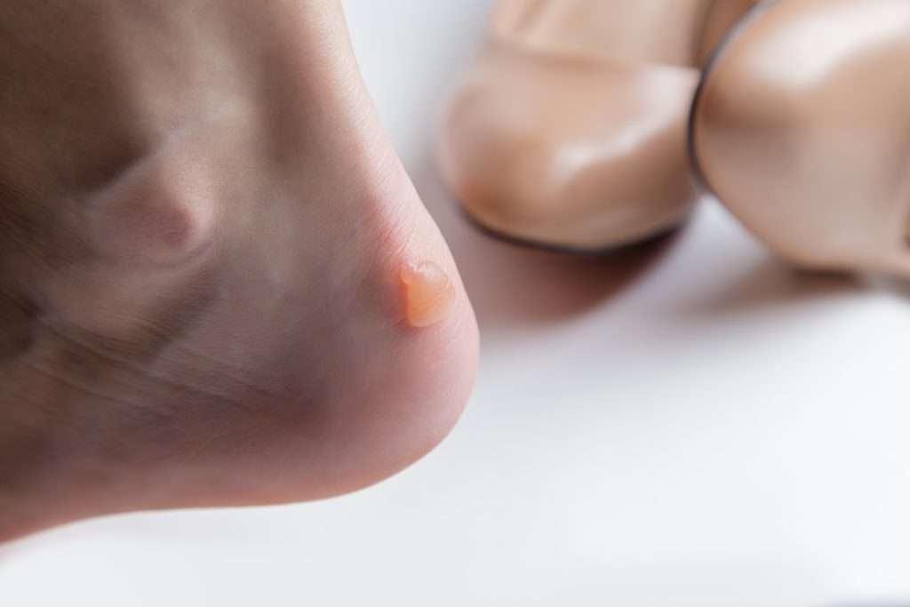 Blisters